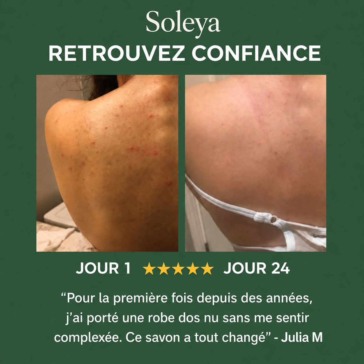 Savon anti acné