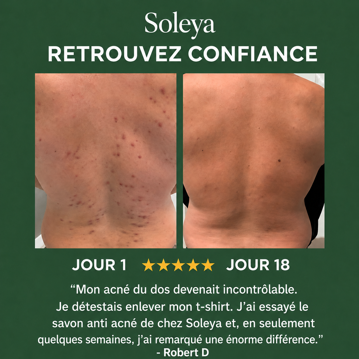 Savon anti acné