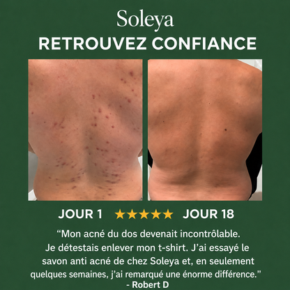 Savon anti acné