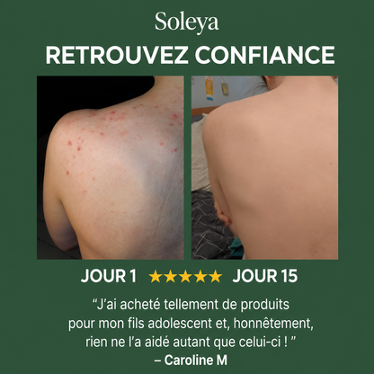 Savon anti acné